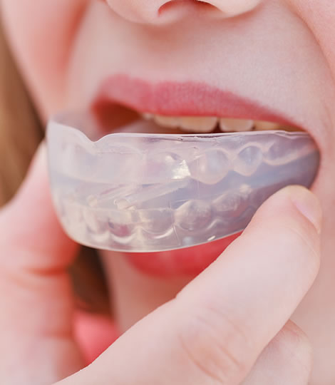 Close-up of a mouthguard being placed on a woman's mouth to protect her teeth. This is one of the services offered at eDental Perth.