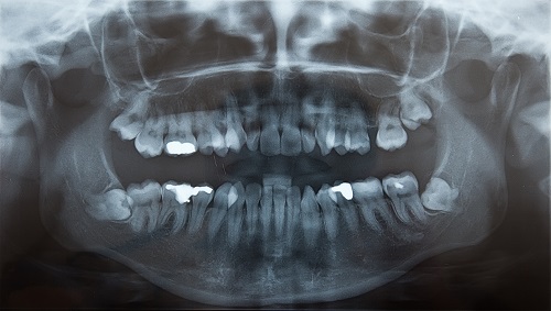 Closed-up result of a teeth x-ray scan, and that represents the 