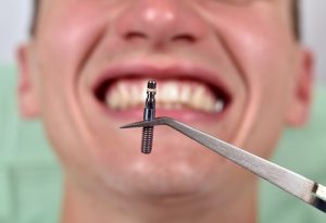 Closed-up of a dental implant on tweezers with a man's teeth as a background and as the header image of 