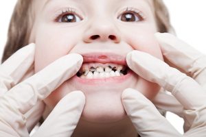 Closed-up of a child's teeth decay and as the header image of 
