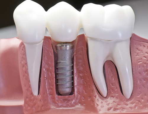 Closed-up of an animated teeth with 1 dental implant and that represents the 