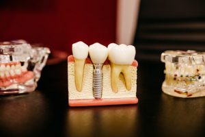 Teeth model with dental implant and crowns which represents the 