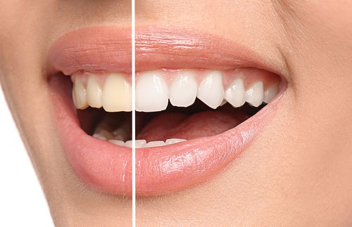 Differentiation of normal and white teeth, and that represents the 